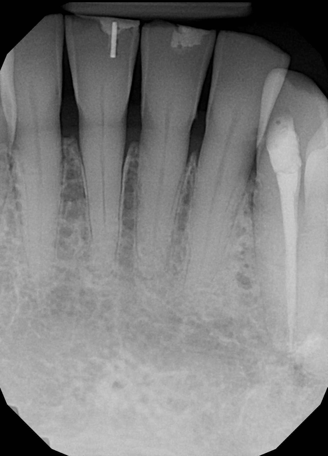 patient x-ray after procedure