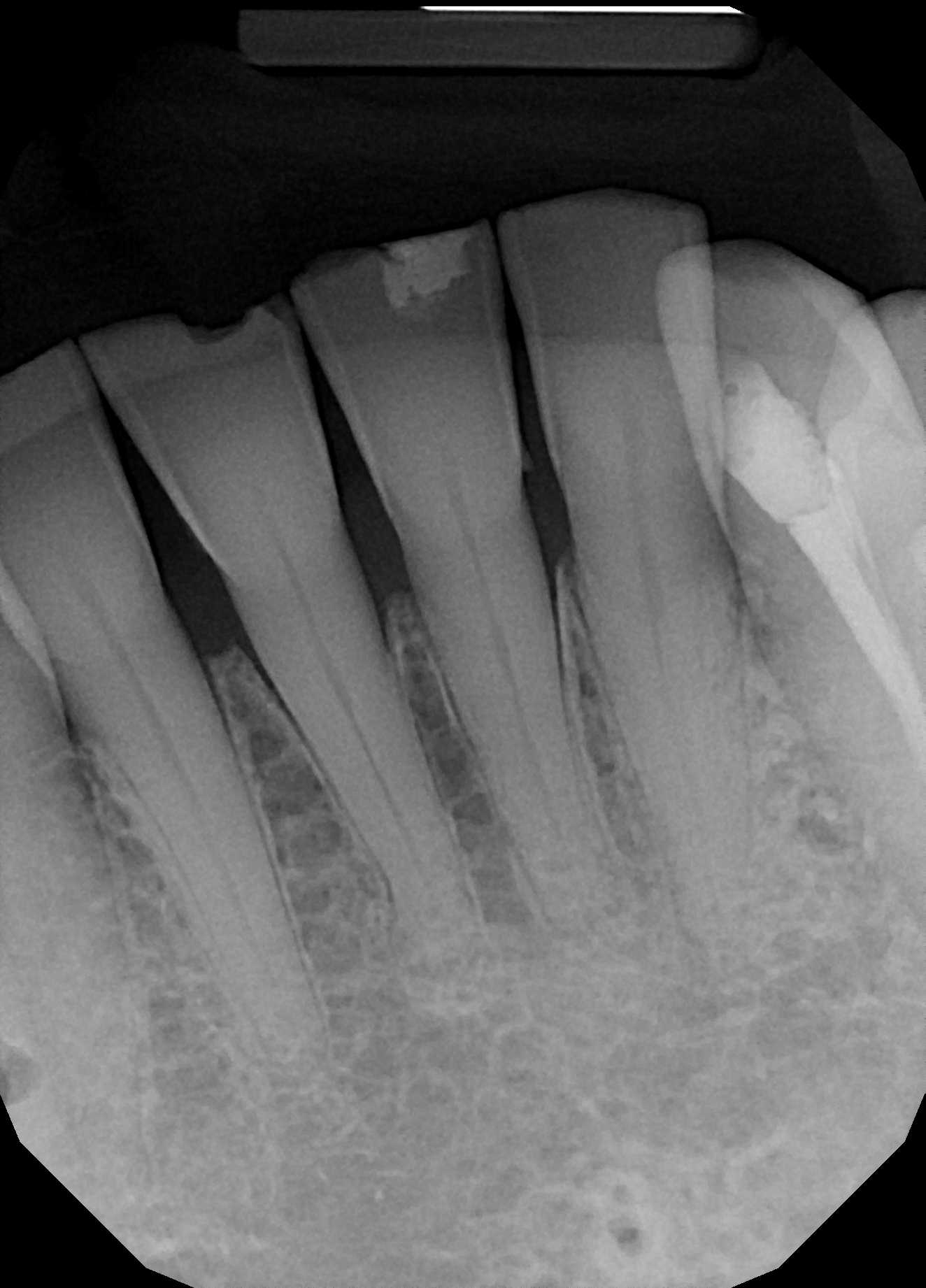 patient x-ray before procedure